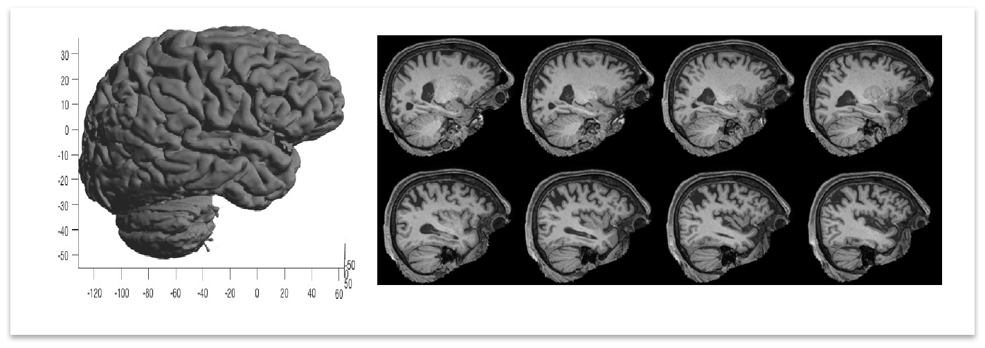 A 3D cortical surface rendering and eight sagittal T1-weighted MRI slices from a 77-year-old man, showing enlarged ventricles and cortical atrophy