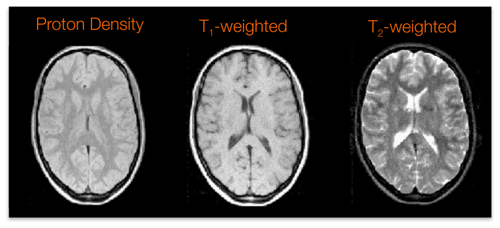 Proton density, T1-weighted, and T2-weighted axial brain images showing different tissue contrasts