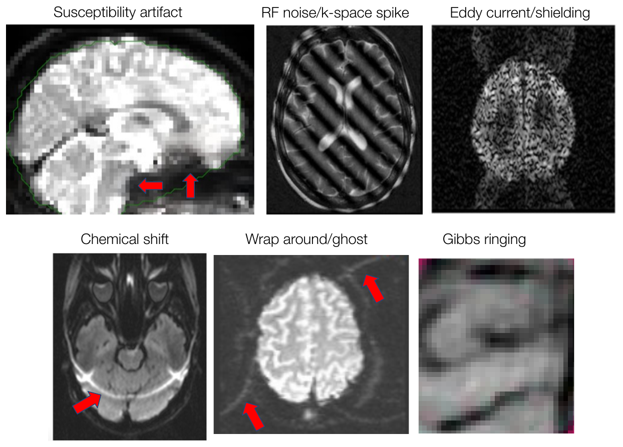 Six example brain images showing susceptibility artifact, RF noise k-space spike, eddy current artifact, chemical shift, wrap-around ghosting, and Gibbs ringing