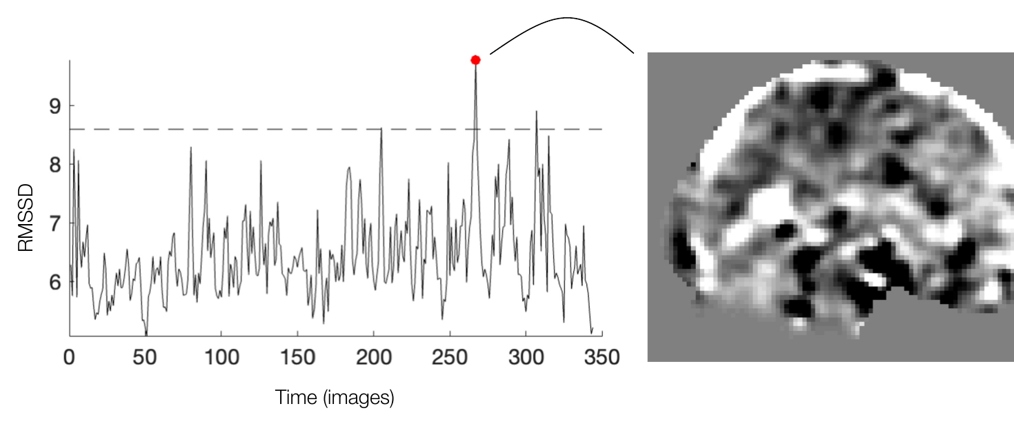 RMSSD time course with a 3 standard deviation threshold line and one flagged volume, next to a sagittal slice showing a broad intensity shift