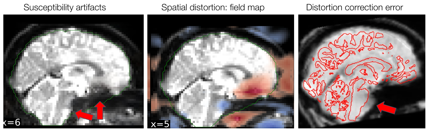 EPI image with susceptibility artifacts, estimated distortion field map in the phase encoding direction, and distortion correction error with overcorrected brainstem