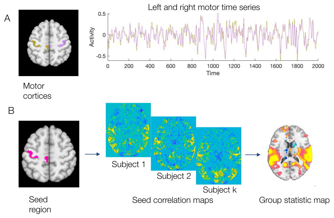 Left and right motor cortex resting-state time series correlate highly; seed correlation maps from several subjects are combined into a group statistic map