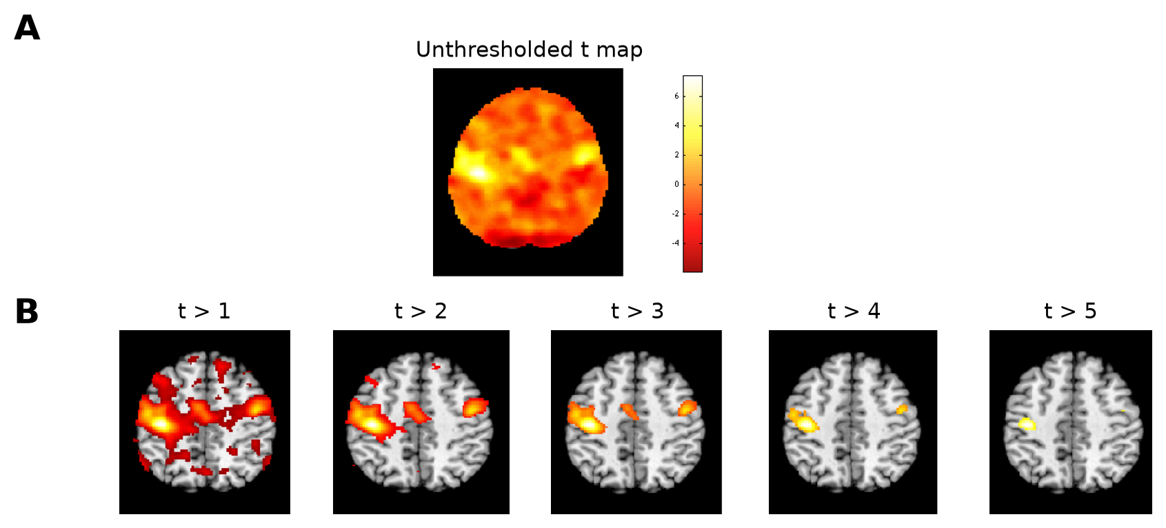 Thresholding at different levels. (A) A t statistic image from a group analysis, with a separate hypothesis test at each voxel. (B) The same image thresholded at five increasingly stringent values; voxels deemed significant are color-coded on an anatomical underlay. The choice of threshold has a large impact on which voxels are deemed active. (Figure 22.1 from the book. © the authors and MIT Press; reproduced with permission — not covered by this site’s CC-BY license.)