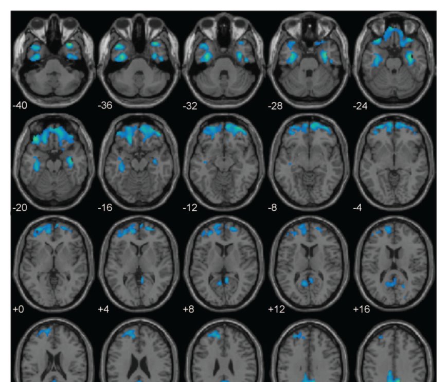 Paralimbic gray matter reductions associated with psychopathy