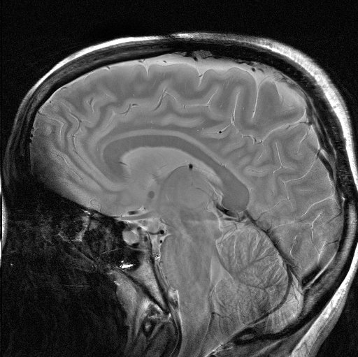 Sagittal T2-weighted structural MRI slice