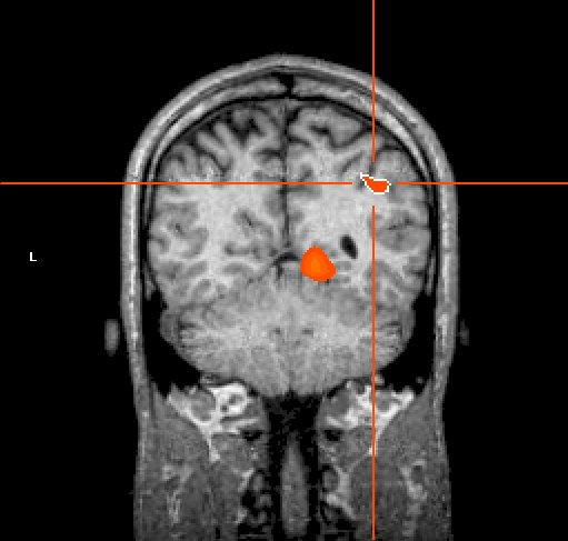 Coronal MRI with focal activation cluster