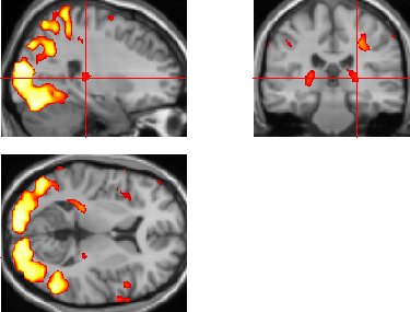 Activation maps overlaid on anatomical slices