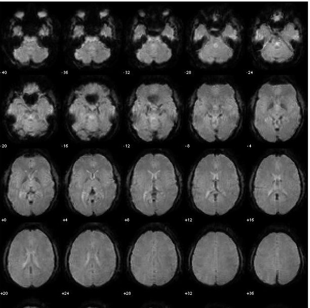Montage of normalized functional slices