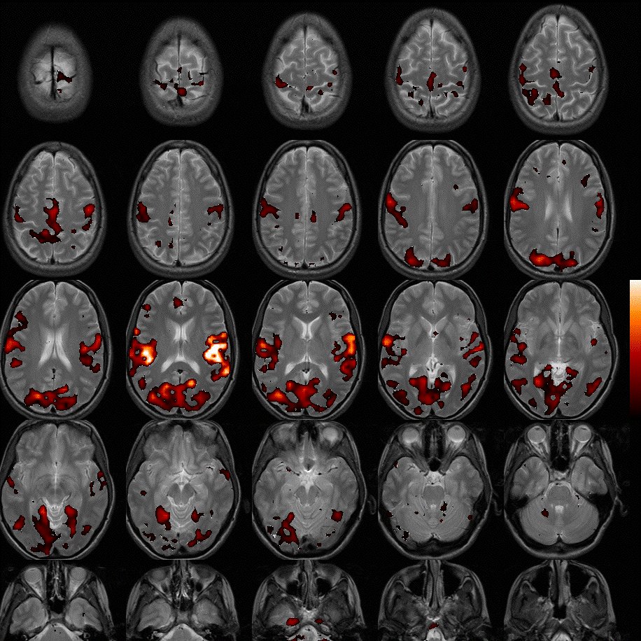 Axial montage of task activation before nuisance filtering