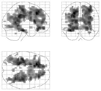 SPM glass-brain projection of a thresholded statistical map