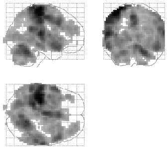Glass-brain map showing widespread global-signal-related effects