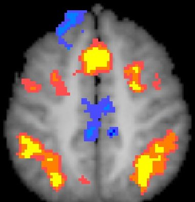 Axial activation map from a well-powered task contrast