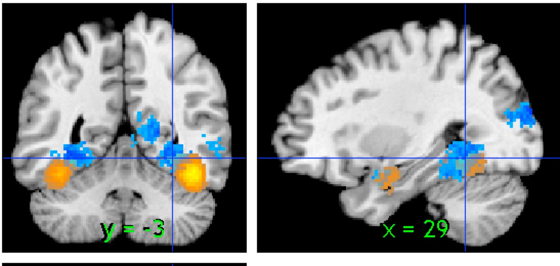 Thresholded contrast map shown in coronal and sagittal views