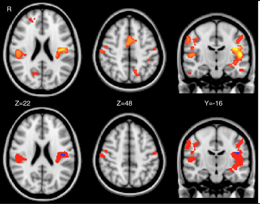Cluster-based versus voxel-based thresholding of a task map
