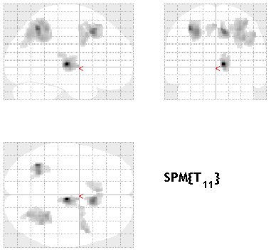 SPM-style glass brain showing thresholded t-statistics